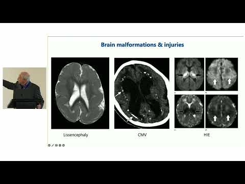 Diagnósticos diferenciales del lactante con hipotonía.Dr. Warren Marks, USA -Inglés.