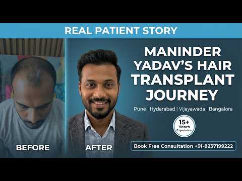 iGraft Pune Hair Transplant Review  Maninder Yadav