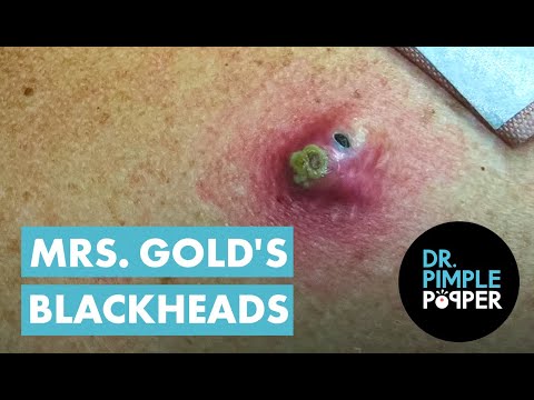 Mrs Gold's Back Blackhead Extraction Session - Addressing the Inflamed One