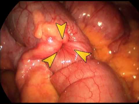 Intussuscepted Meckel's Diverticulum - Laparoscopic Resection