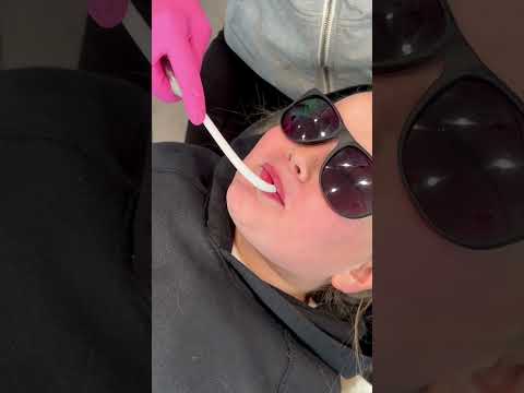 Braces On And Palatal Expander In 🦷 Here Are The Steps For Phase I Braces