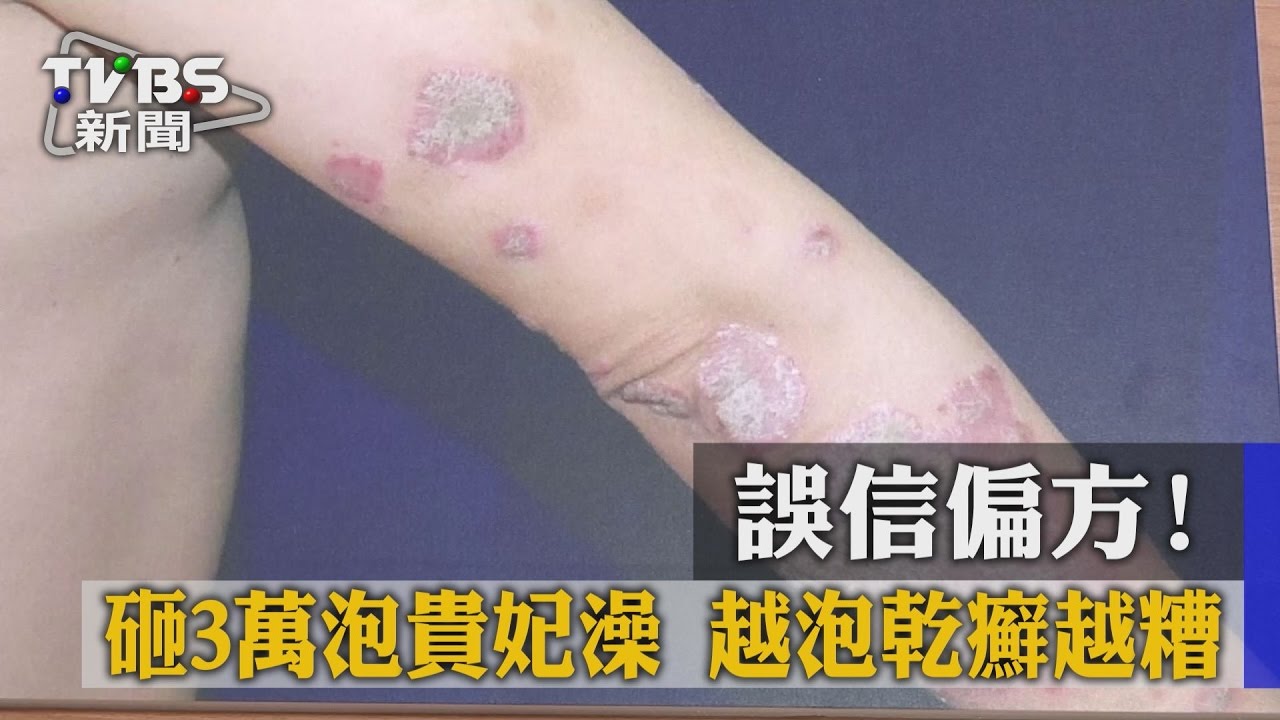 誤信偏方!砸3萬泡貴妃澡 越泡乾癬越糟