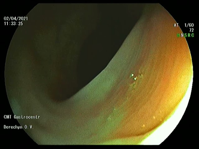 Колоноскопия в инверсии на выходе от купола до ануса.