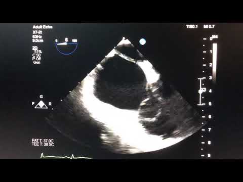 Live 3D Narrow-sector acquisition for an RA Mass
