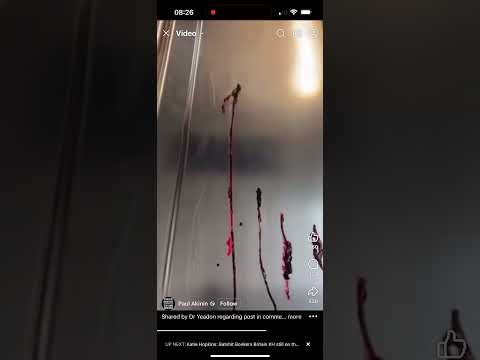 Myocarditis and blood clots #covid #myocarditis #blood clots forensics