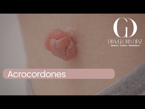 Acrocordones