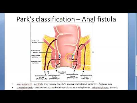 Surgery 806 Parks classification anal fistula types fistula in ano Intersphincteric transsphincteric