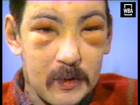 1983 NEWS SPECIAL: AIDS in America | Early AIDS Documentary