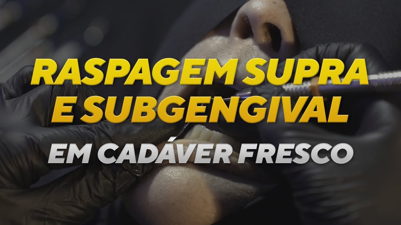 Como realizar a raspagem supra e subgengival. Demonstração em cadáver fresco