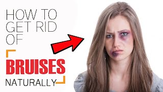 How to Get Rid of Bruises Quickly || Home Remedies for Bruises Treatment