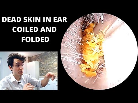 Tightly coiled dead skin blocking the ear extracted (pre keratosis obturans discussed)
