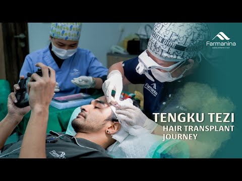 Tengku Tezi Hair Transplant Journey