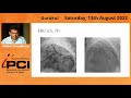 DR NIKHIL CHOUDHARY ROTABLATION AND IVUS GUIDED MV PCI IN HIGH SYNTAX SCORE CAD