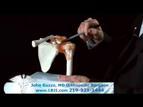 Dr. John Guzzo Explains SLAP Lesions