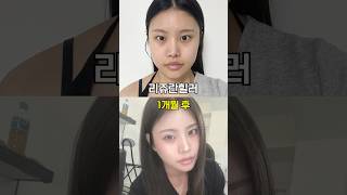 속건조 한 번에 잡는 리쥬란 전후