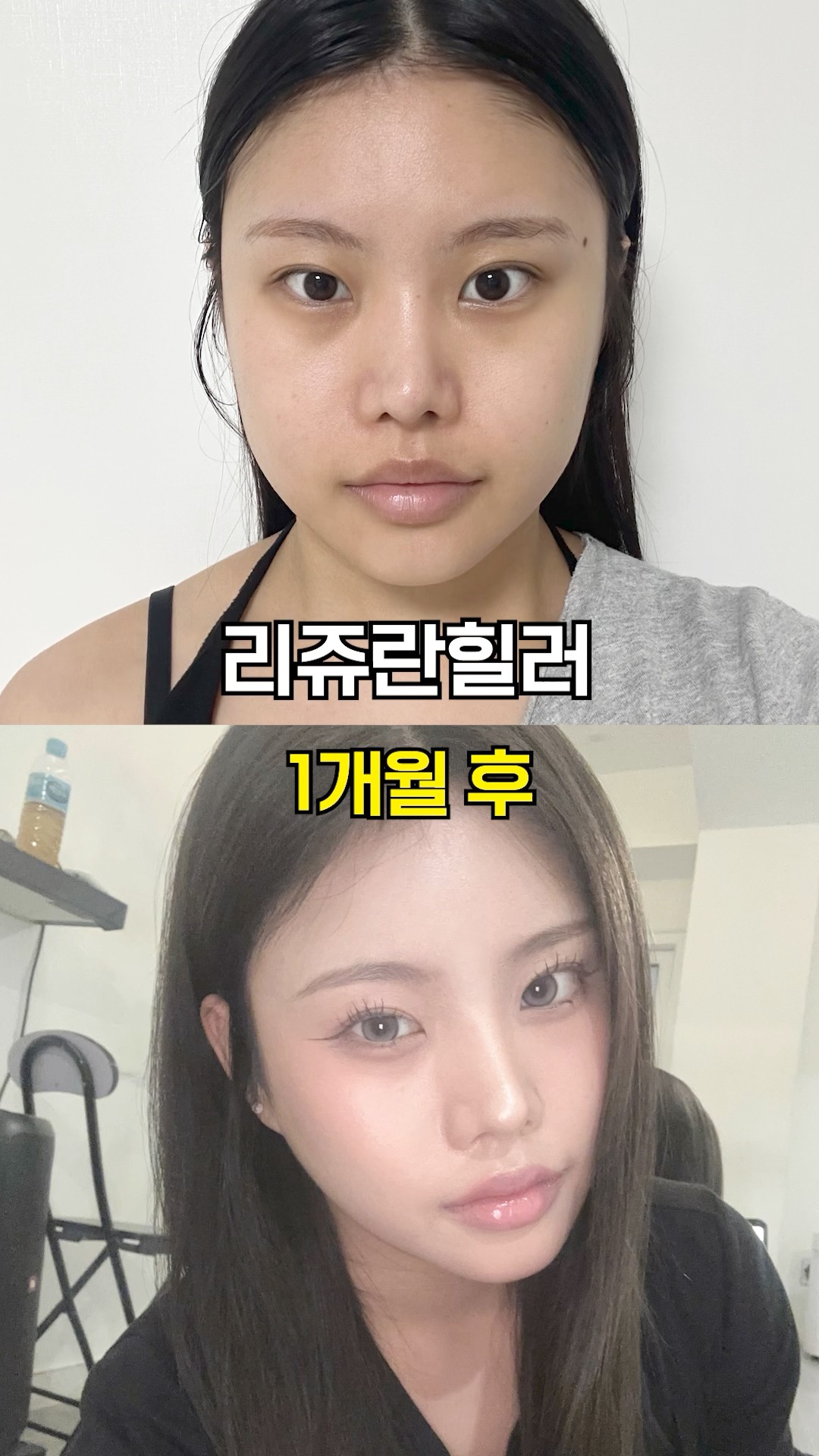 속건조 한 번에 잡는 리쥬란 전후