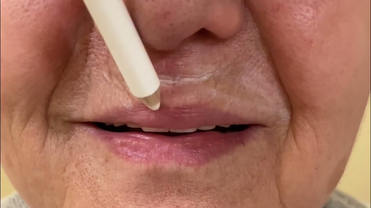 Watch Correción Código de barras o arrugas peribucales con ácido hialurónico - Dr Martin Gaston Alvarez Now Correción Código de barras o arrugas peribucales con ácido hialurónico - Dr Martin Gaston Alvarez