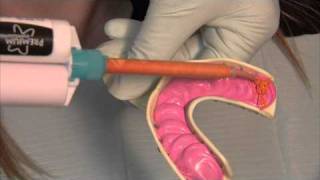 How to take one-step impressions