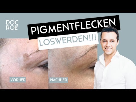 Cryopen: entfernt Pigmentflecken sicher & schnell!