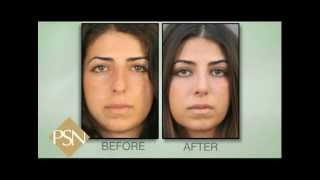 Rhinoplasty on Beverly Hills Female, Amazing Results!