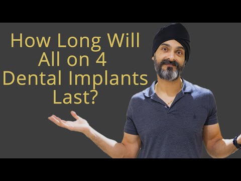 How long do All on 4 or a Full Set Of Implants Last?