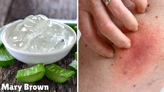 Here how you can get rid of inner thigh rashes.