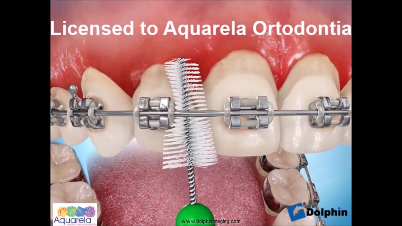 Escovação com aparelho ortodôntico - escova interdental