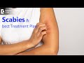 Itching & rashes on Skin- Is it Scabies?Symptoms, Causes & Treatment- Dr. Nischal K |Doctors' Circle