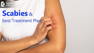 Itching & rashes on Skin- Is it Scabies?Symptoms, Causes & Treatment- Dr. Nischal K |Doctors