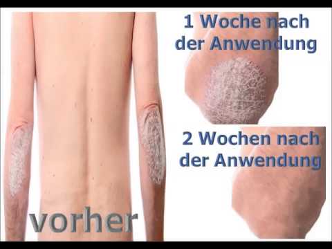 Von der Schuppenflechte nehmen die Armee nicht Ob vom Krebs die Patientinnen von der Schuppenflechte schmerzen