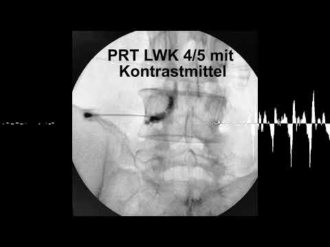 PRT: Der präzise Weg raus aus dem Ischiasschmerz
