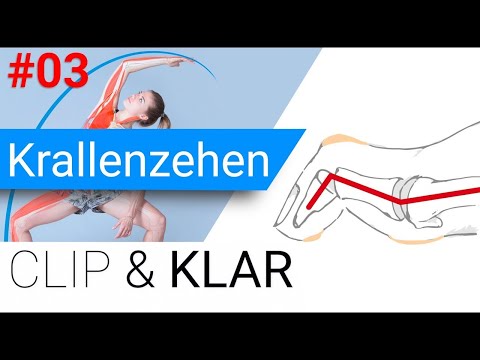 Krallenzehen & Co erklärt - vorne gekrallt, Grundgelenke überstreckt