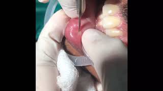 Mucocele lower lip Excision