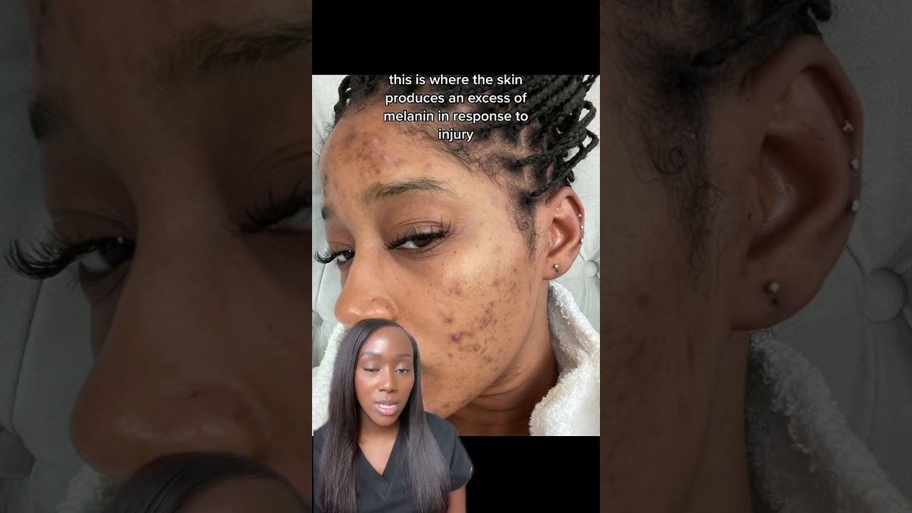 Types of Hyperpigmentation