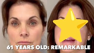 61 Year Old – Every Facelift Patient Heals Differently