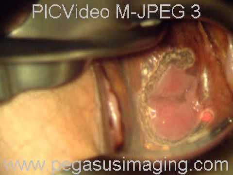 comment guerir condylome