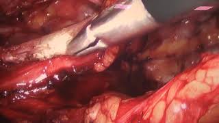 Hernirrafia inguinal esquerda por video / Video inguinal hernia repair Hernirrafia inguinal esquerda por video / Video inguinal hernia repair