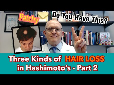 Three Kinds of Hashimoto's Hair Loss - part 2 - patchy alopecia areata (what It means & what to do)