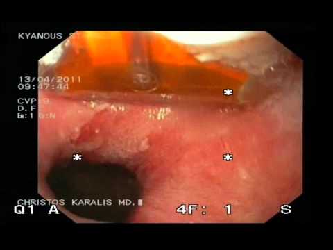 Radiofrequency Ablation Of Halo 90 Method After Endoscopic Mucosal Resection Of Cancerous Nodule.