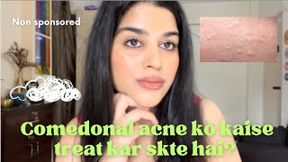 How to get rid of comedones| How to treat comedonal acne| how I treated my acne #acne #skincare