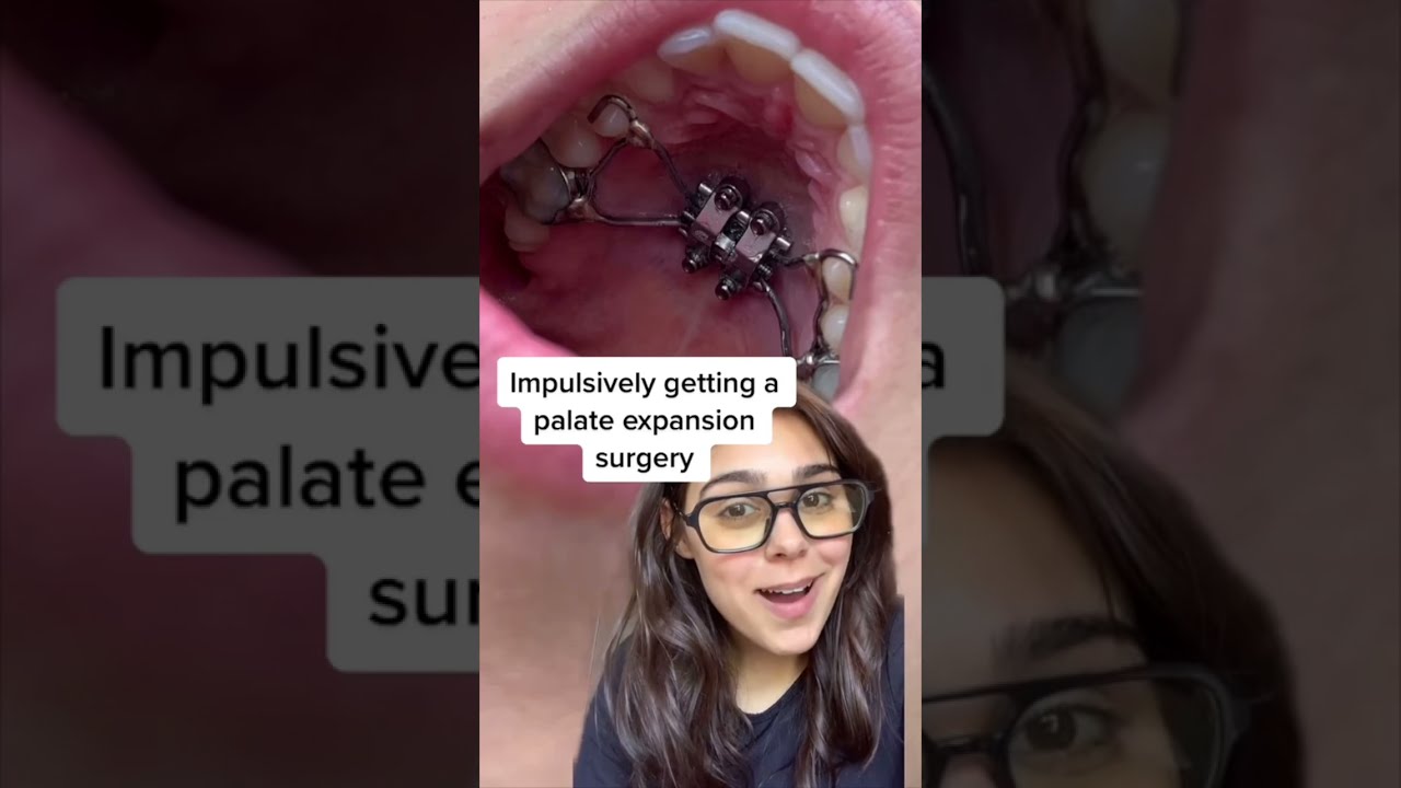 Orthodontist Reacts: Giant Tooth Gap From Expander And Jaw Surgery 😬 #shorts