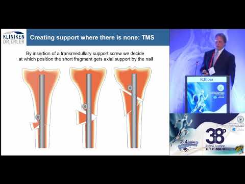 Biber R. - Tips & tricks for nailing in comminuted fractures