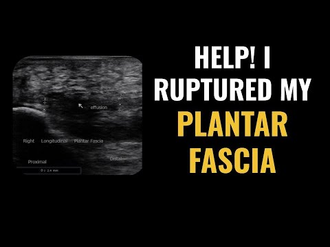 Ruptured Plantar Fascia (Fasciitis) | How to Diagnose and What are the Treatment Options?
