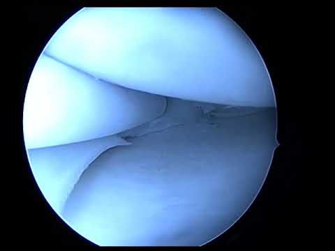 Artrita artroza tratamentul injecțiilor articulațiilor genunchiului
