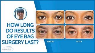 How Long Does Eye Bag Removal Surgery/ Lower Blepharoplasty Last?