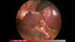 TPEA Lifter - Reduced Port Cholecystectomy