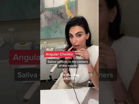 Mundwinkelrhagaden #shorts #kurzvideo