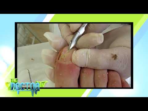 El ungüento salicílico al hongo de las uñas Como sanar el hongo entre los dedos y sobre las uñas