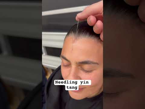 Yin tang acupuncture point
