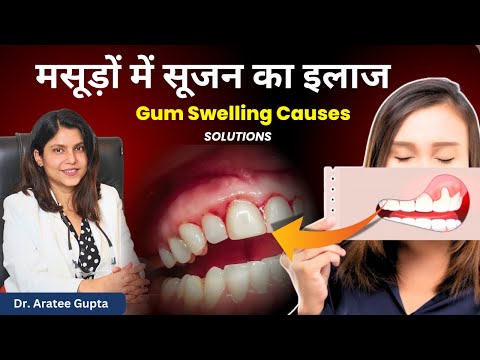 Gum Swelling Causes & Treatment l Dr. Aratee Gupta